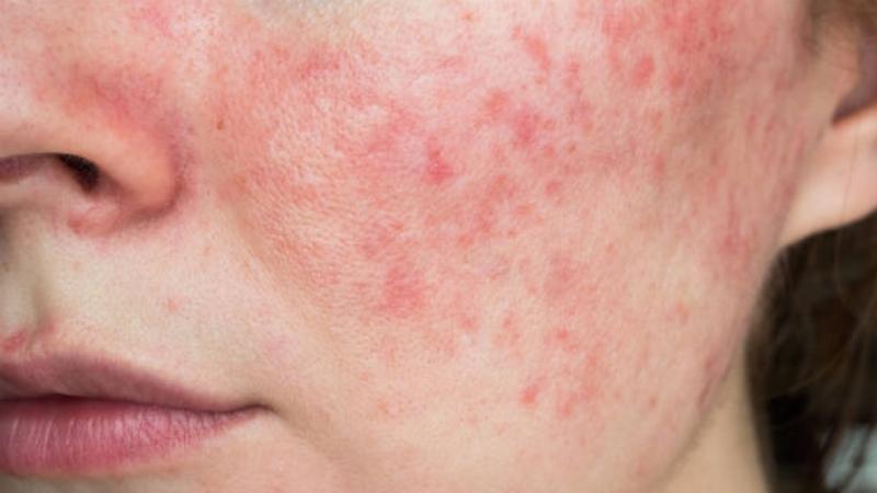 Những lưu ý quan trọng khi sử dụng serum La Roche-Posay an toàn và hiệu quả